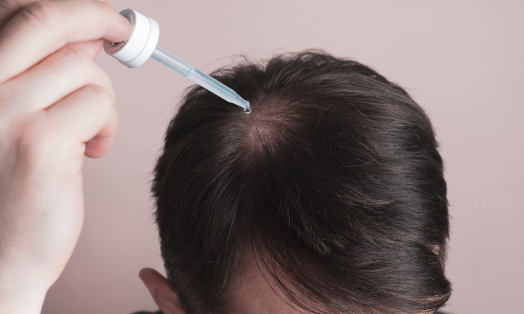 Minoxidil được chỉ định trong điều trị rụng tóc hiện nay Minoxidil được chỉ định trong điều trị rụng tóc hiện nay