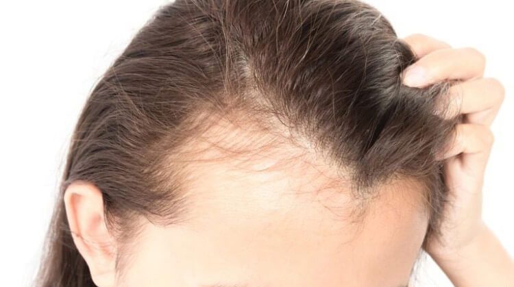 Có nhiều nguyên nhân khác nhau gây ra tóc mọc không đều