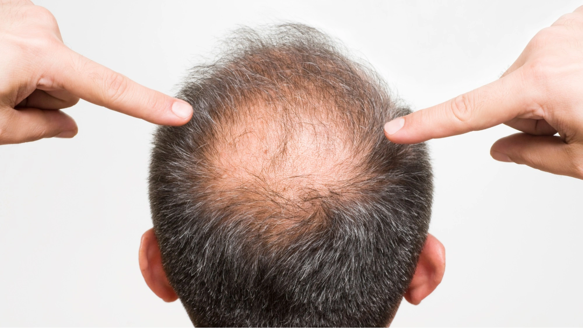 Nguyên nhân rụng tóc ở nam là gì? Cách khắc phục rụng tóc