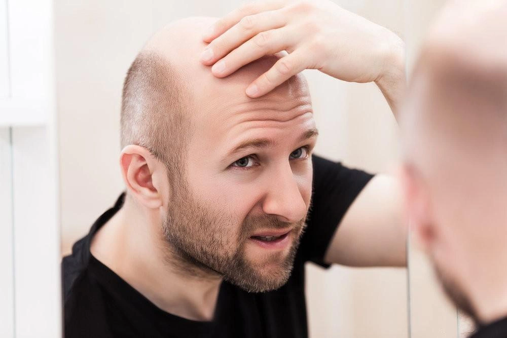 Hói có di truyền không? Làm sao khắc phục tình trạng hói
