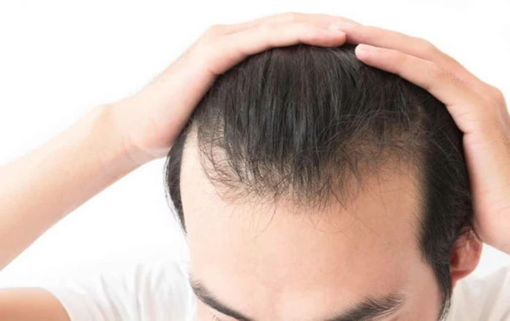 hói có di truyền không