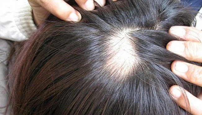hói có di truyền không
