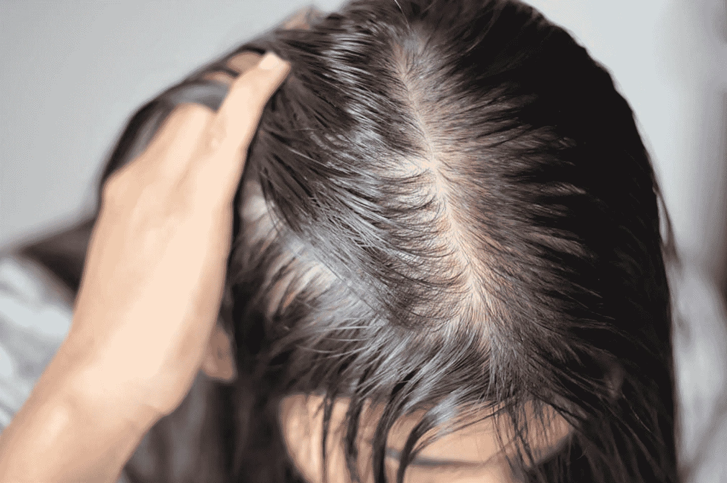 hói có di truyền không