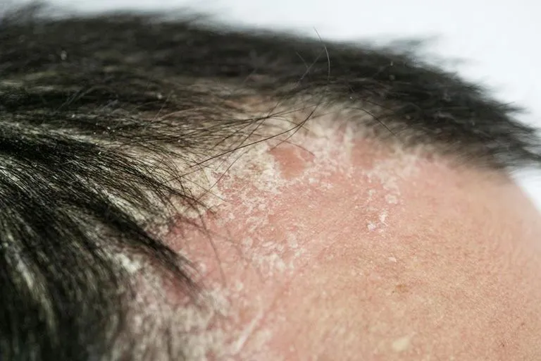 bị gàu có nên gội đầu nhiều