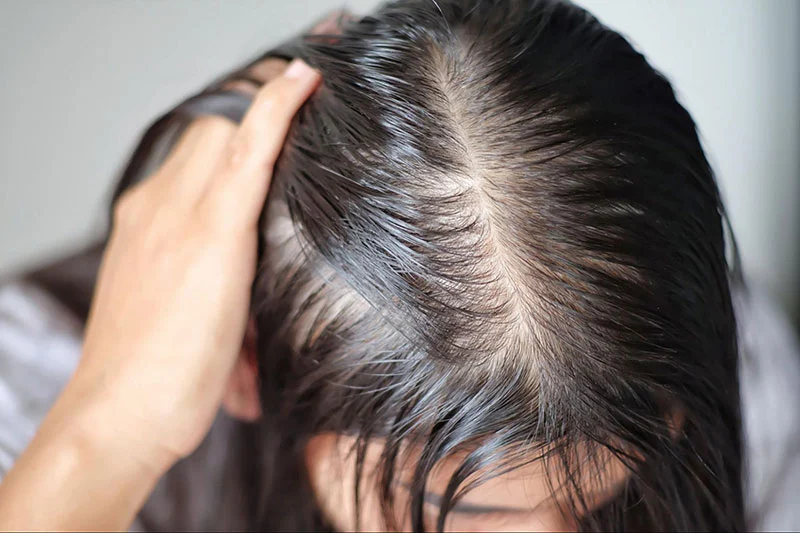 bị ở đỉnh đầu ở nữ
