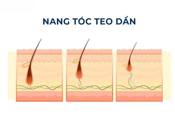Nang tóc bị teo: Vì sao tóc không mọc lại và cách cải thiện từ gốc