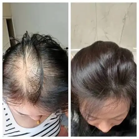 nang tóc bị teo