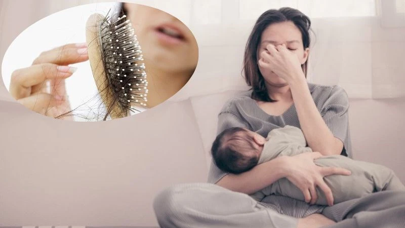 rụng tóc sau sinh