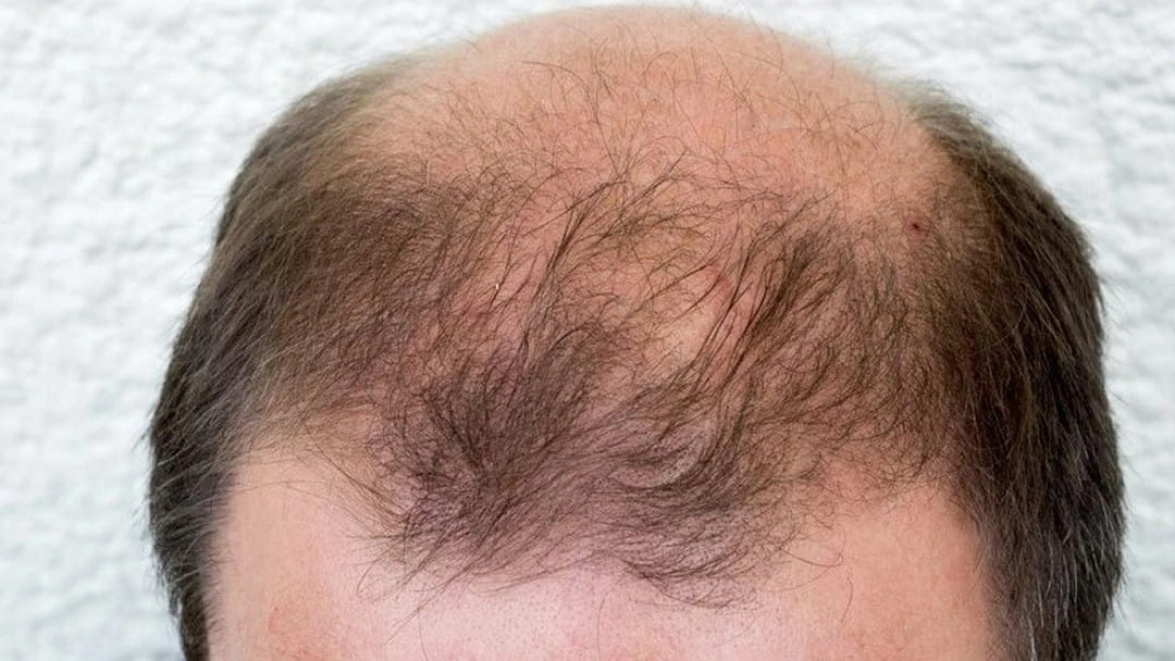 Tại sao nam giới hói đỉnh đầu? Cách cải thiện hói đỉnh đầu