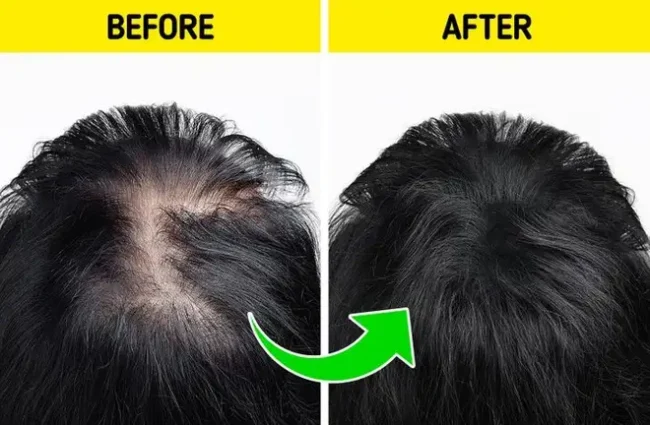 9+ Cách mọc tóc nhanh hiệu quả chỉ trong 1 tuần