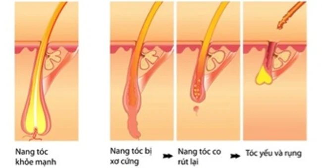 nang tóc bị tổn thương và rụng tóc